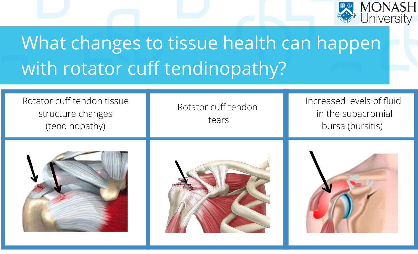 Changes to tissue health – Shoulder Care Australia